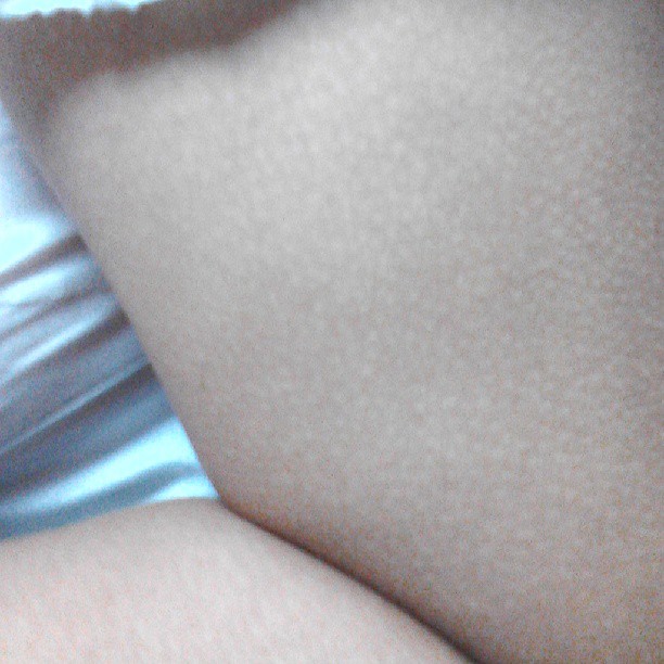 2013/08/30 — 同事胳膊上的鸡皮疙瘩，（文琼拍）