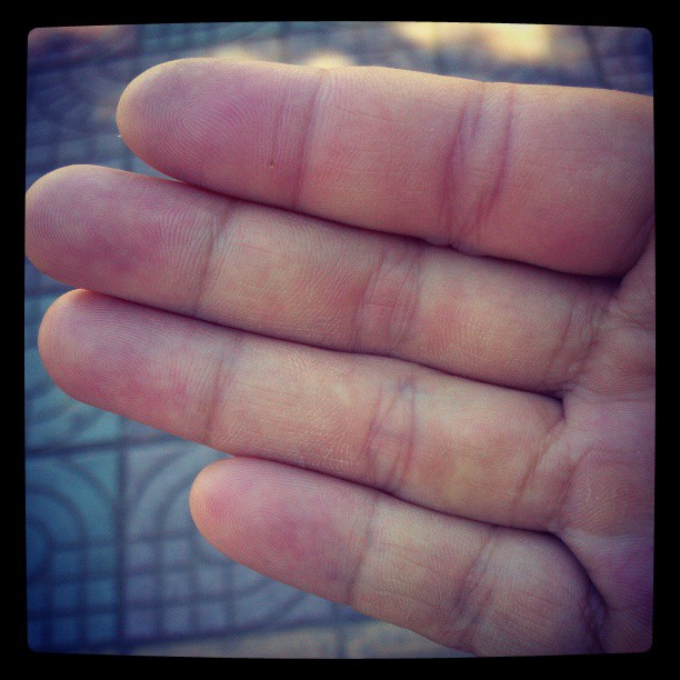 2013/08/31 — 有木有感觉有点肿，有个手指被马蜂蛰了，快一个星期了