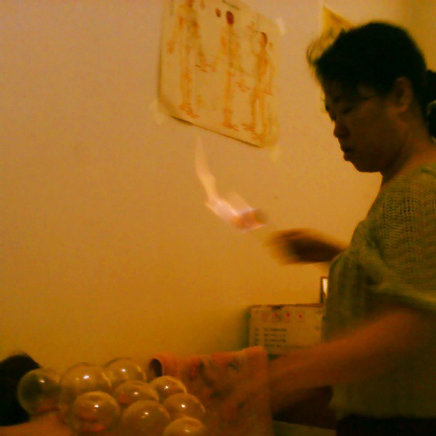 2013/08/04 — 这人拔罐的技术可高啦。【来自海英拍摄】